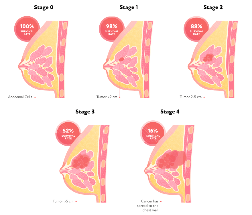Breast cancer stages graphic