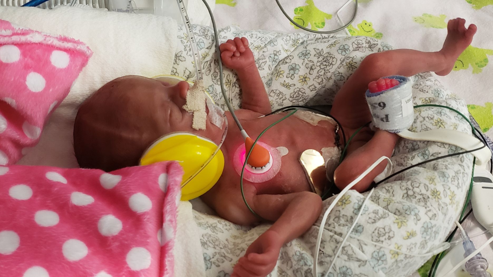 a nicu baby sleeps with supporting oxygen at renown childrens hospital