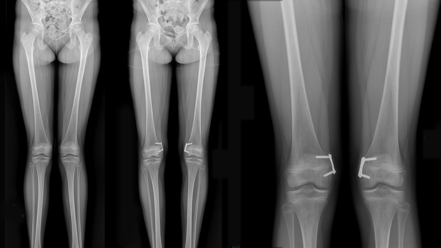 X-ray of Genu valgum (knock-knees) 