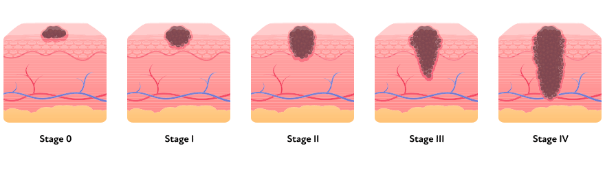 Graphic showing the 5 stages of melanoma